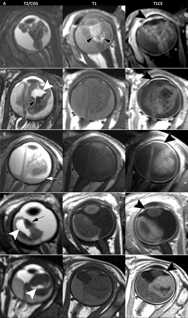 Example T2-weighted constructive interference in steady state (CISS), T1-weighted noncontrast, and T1-weighted contrast-enhanced (CE) images in five children with MYCN-amplified RB1 wild-type (MYCNARB1+/+) retinoblastoma show typical MRI phenotypes in an (A) 11-month-old boy, (B) 4-month-old girl, (C) 6-month-old boy, (D) 3-month-old girl, and (E) 4-month-old girl. Typical MRI features include anterior tumor location, irregular tumor margins, plaque or pleomorphic shape, a diffuse growth pattern, and numerous tumor lesions. Peritumoral hemorrhage is shown (black arrows in A, B, and D). T1 hyperintensity suggests the presence of peritumoral blood in A. Subretinal hemorrhagic fluid-fluid level is shown (white arrow in C). Tumor-retina folding with enclosure of the vitreous is denoted (white arrowheads in B, D, and E). Strong enhancement of the anterior eye segment is present in all five patients (black arrowheads on T1-weighted sequences with gadolinium-based contrast agent).