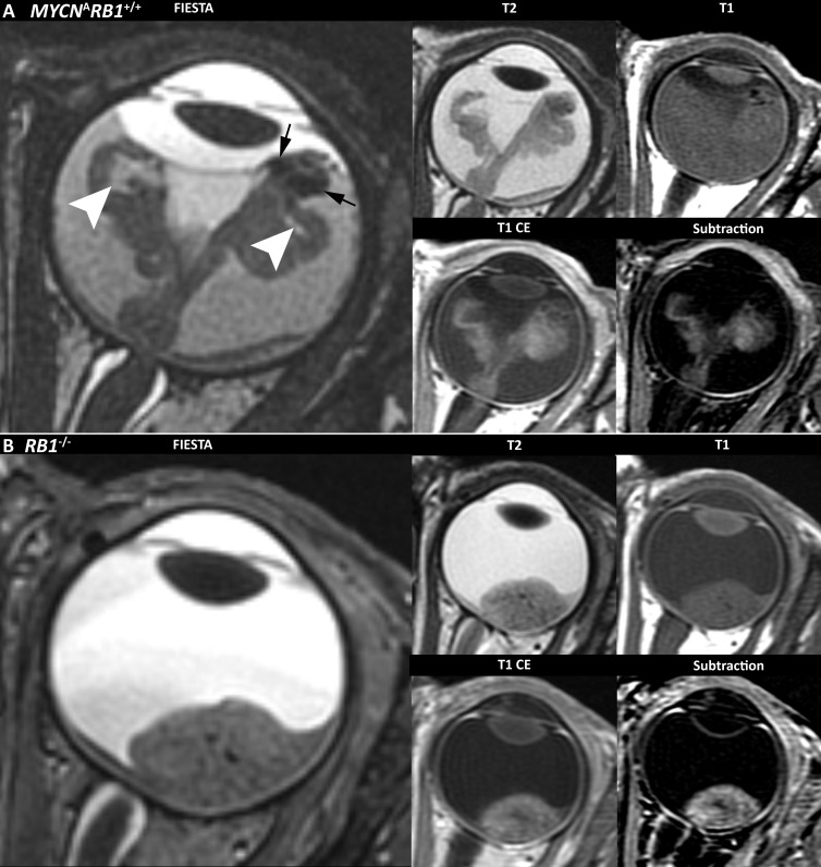 MRI phenotype MYCN-amplified RB1 wild-type (MYCNARB1+/+) retinoblastoma versus retinoblastoma driven by RB1 pathogenic variation (RB1−/−). (A) Representative MRI scans in a 42-month-old boy with MYCNARB1+/+ retinoblastoma show relatively anterior tumor location, irregular margins, a pleomorphic shape, tumor-retinal folding with retina-retina contact (arrowheads), and peritumoral blood (arrows). Axial T1-weighted images with and without gadolinium-based contrast agent, T2-weighted image, and subtraction image are included. (B) MRI scan in a 10-month-old girl with RB1−/− retinoblastoma shows a posterior location, smooth margins, and a lens shape without vitreous inclusion or peritumoral blood. Axial T1-weighted images with and without gadolinium-based contrast agent, T2-weighted image, and subtraction image are included. CE = contrast enhanced, FIESTA = fast imaging employing steady-state acquisition.