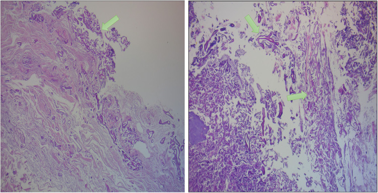 Clinical Manifestation, mNGS Based Diagnosis and Treatment of Pulmonary ...