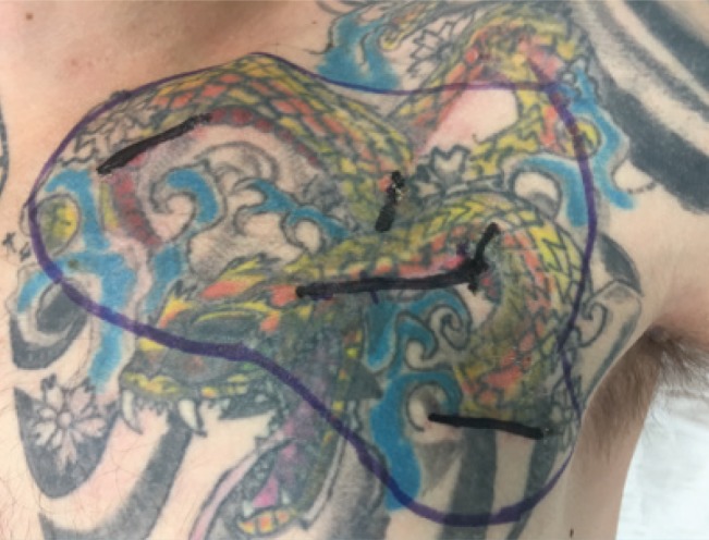 Malignant Melanoma Arising in Red Tattoo Ink - PMC