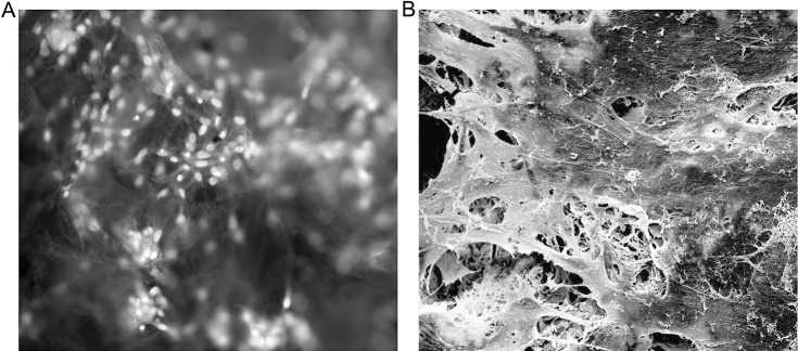 Figure 1. Microscopic observations of PDLtm. (A) Scaffolded, spindle-shaped PDLCs growing densely, with green-yellow nuclei and orange-red cytoplasm, under fluorescence inverted microscope after arcidine orange staining (×200). (B) Integration of PDLCs, secreted extracellular matrix, and PLGA scaffolds observed under SEM (×1200).