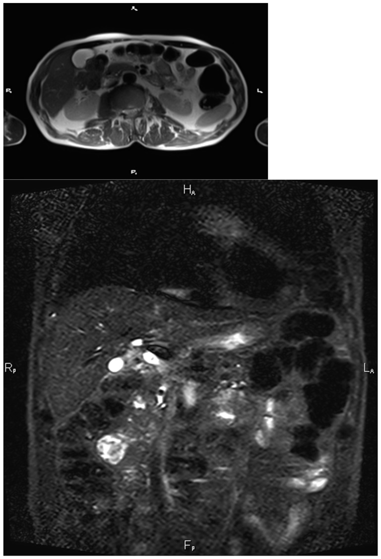 Acute Cholecystitis from Biliary Lithiasis: Diagnosis, Management and ...