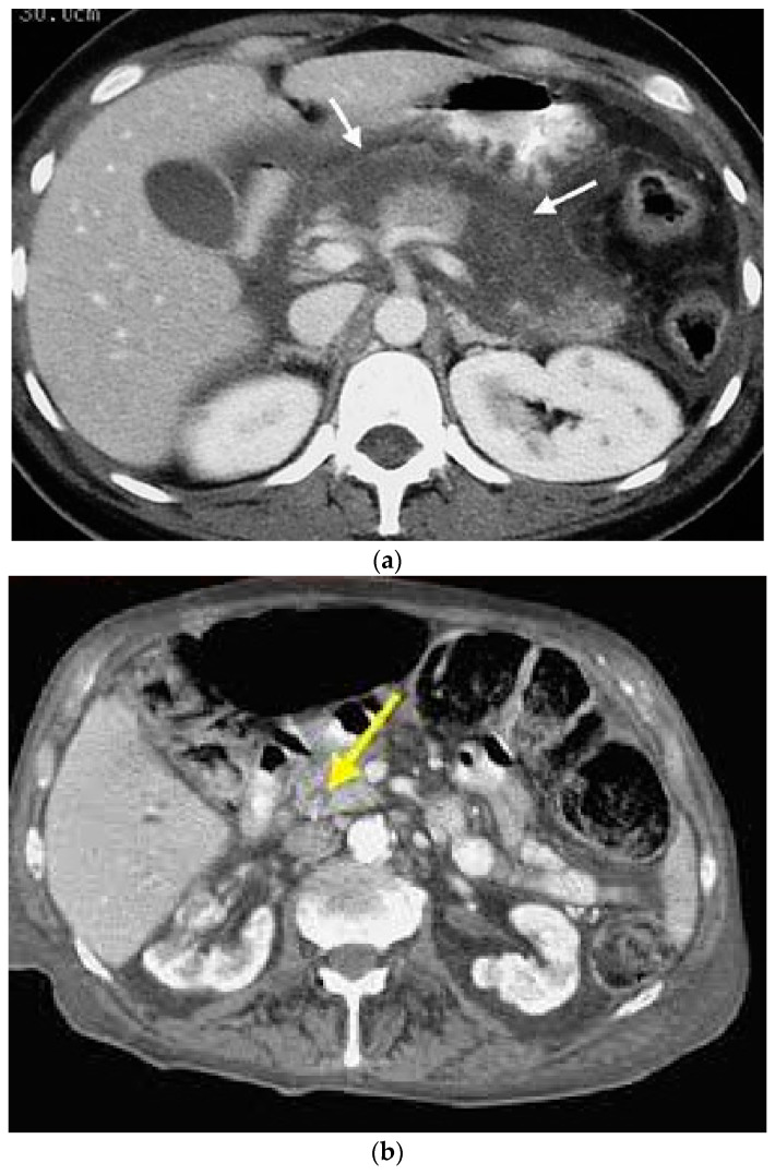 Acute Cholecystitis from Biliary Lithiasis: Diagnosis, Management and ...