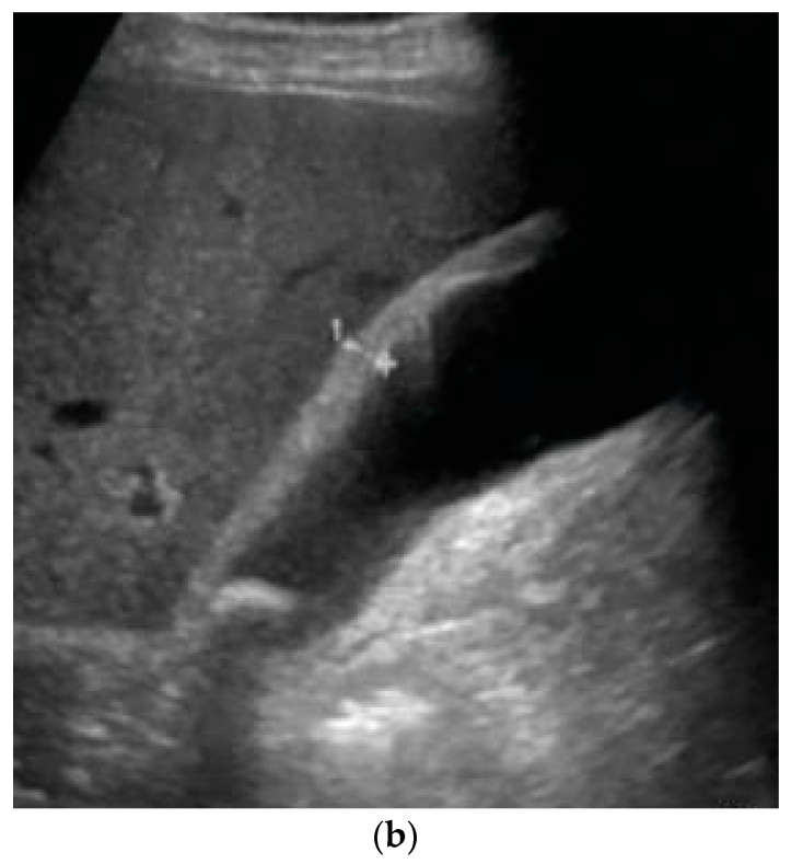 Acute Cholecystitis from Biliary Lithiasis: Diagnosis, Management and ...