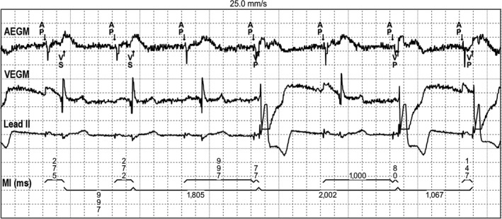 Switch between AAI and DDD mode pacing—What is the mechanism? - PMC