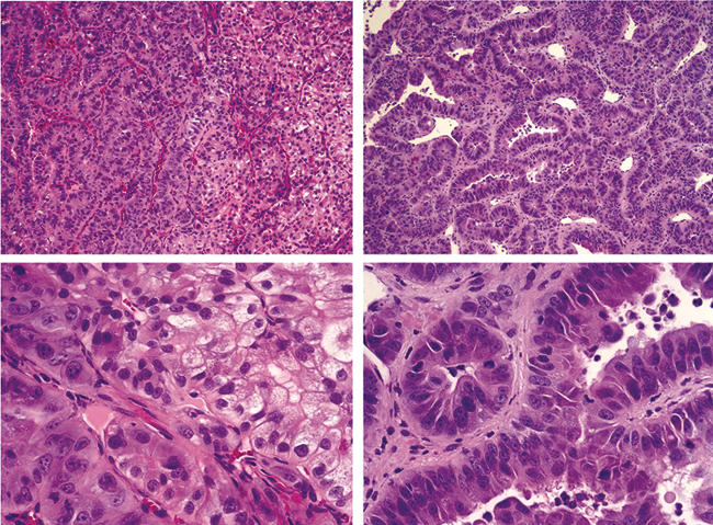 Tumor suppression by HIF2α shRNA