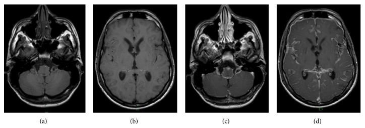 Meningeal Melanomatosis: A Challenge for Timely Diagnosis - PMC