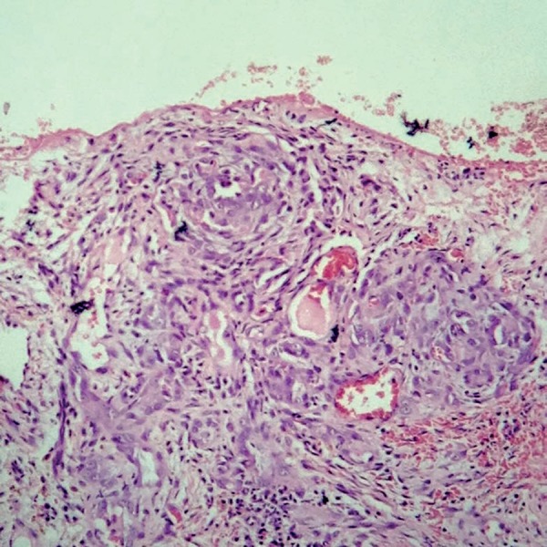 Tufted angioma - PMC