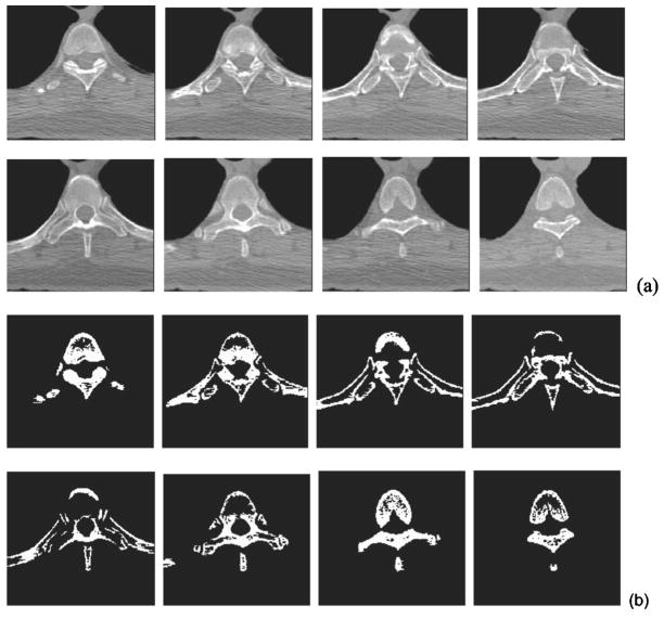 Pulmonary nodule registration in serial CT scans based on rib anatomy ...