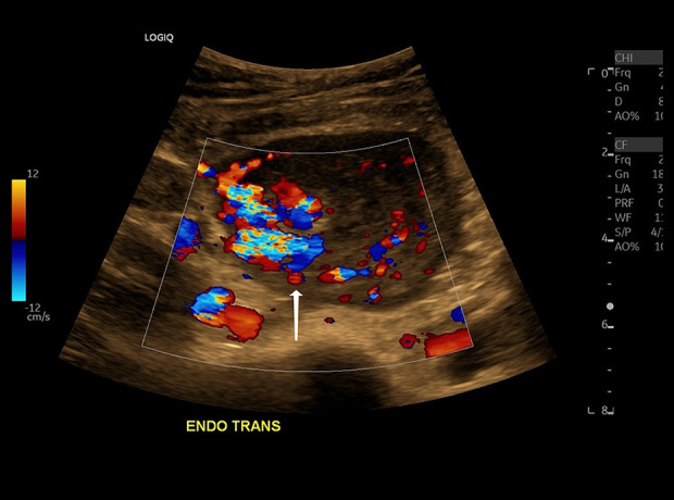 Uterine Arteriovenous Malformation (AVM) – a Potentially Life ...