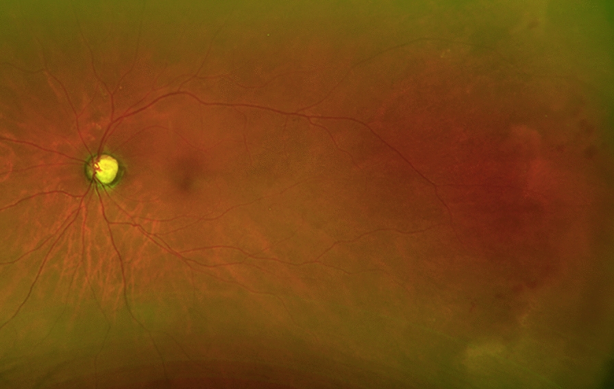 Diagnostic retinal biopsy in the management of secondary non-CNS ...