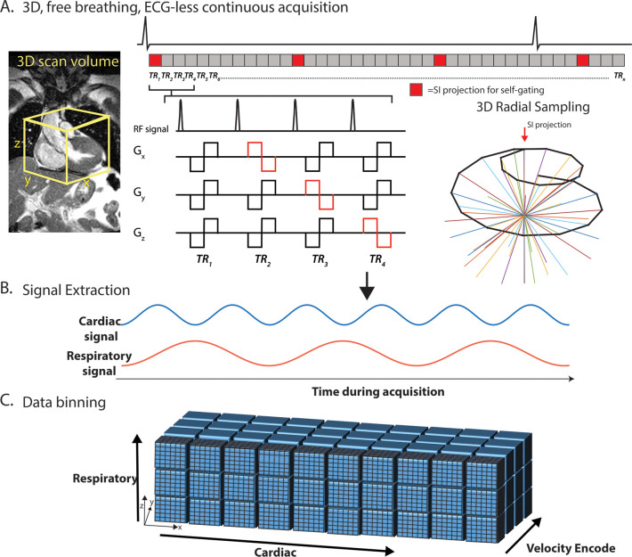 Five-dimensional flow MRI framework. A, Pulse sequence: continuous acquisition with spatial encoding following a three-dimensional (3D) radial, spiral phyllotaxis sampling pattern, interspersed with superior-inferior (SI) projections, which were used to extract, B, cardiac and respiratory self-gating signals. Bipolar flow–encoding gradients were added to spatial-encoding gradients in patterns of four successive repetition times (TR) required for 3D velocity-encoding. The total number of TRs per interleaf has been reduced in this figure for demonstration purposes (see Methods). C, Data are retrospectively binned into cardiac, respiratory, and velocity-encoded dimensions and gridded onto Cartesian coordinates for reconstruction using a compressed-sensing framework with a data-fidelity term and cardiac and respiratory regularization. The electrocardiogram (ECG) is shown for demonstration purposes only. TR representations are lengthened relative to the ECG. Gx, Gy, and Gz represent the magnetic gradients in the x, y, and z directions, respectively. RF = radiofrequency pulse.