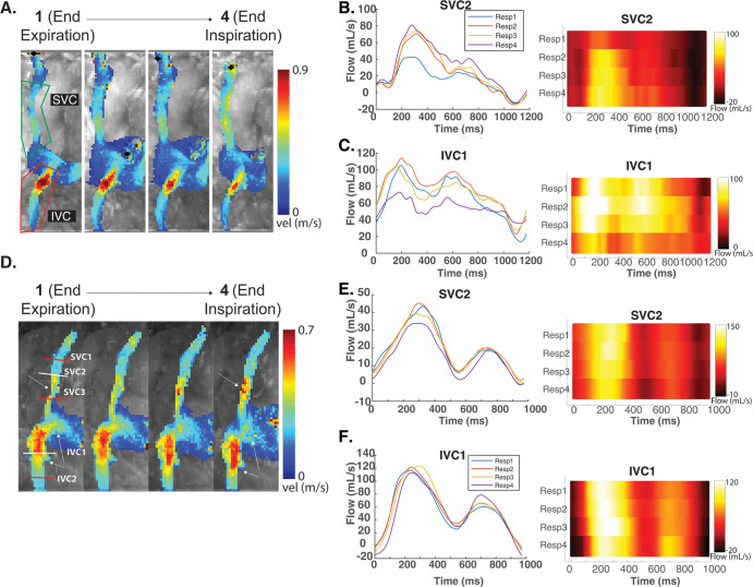 A–C, Respiration-resolved evaluation of three-dimensional hemodynamics in a 65-year-old man with thoracic aortic aneurysm and no valve disease (heart rate, 50 beats per minute during imaging). A, Evaluation of caval inflow (superior vena cava [SVC] and inferior vena cava [IVC]) into the right atrium shows some increased peak velocities in the SVC and decreased velocities in the IVC at end expiration. B, C, Color maps reveal an increase in IVC peak flow and a potential temporal flow shift in this participant. D–F, Respiration-resolved evaluation of three-dimensional hemodynamics in a 61-year-old woman with a bicuspid aortic valve (heart rate, 59 beats per minute during the imaging) shows similar hemodynamic patterns. SVC and IVC color maps show differences in potential temporal shifts between respiratory flow curves. This participant also has noticeably less-noisy flow curves than the participant in A–C. See Movies 4–7 (supplement). IVC1 = IVC plane 1, IVC2 = IVC plane 2, Resp 1 = end expiration, Resp 2 = intermediate respiratory position more proximal to Resp 1, Resp 3 = intermediate respiratory position more proximal to Resp 4, Resp 4 = end inspiration, SVC = superior vena cava, SVC1 = SVC plane 1, SVC2 = SVC plane 2, SVC3 = SVC plane 3.