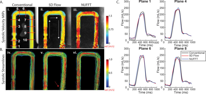 Results from in vitro studies. A, Peak systolic velocity maximum intensity projections (MIPs) show hemodynamics among i, conventional four-dimensional (4D) flow data (1–10, 10 planar locations for flow quantification); ii, five-dimensional (5D) flow–reconstructed data; and iii, nonuniform fast-Fourier transform (NUFFT) data (gridded, no compressed-sensing reconstruction). B, Peak systolic streamlines show similar hemodynamics among iv, conventional 4D flow data; v, 5D flow–reconstructed data; and vi, nonuniform NUFFT data. C, Four representative flow curves show good agreement between 5D and conventional 4D flow data. The MIPs project the maximum velocities onto the imaging plane. Although MIPs are useful for a simple three-dimensional representation of peak velocities, these numbers are likely higher in the NUFFT data without compressed sensing, because this reconstruction is much noisier than the compressed-sensing reconstruction (as compressed sensing aims to remove aliasing artifacts). Because the MIPs are a projection of the absolute velocity, all noise values that increase the absolute velocity value of a voxel are captured as higher velocities.