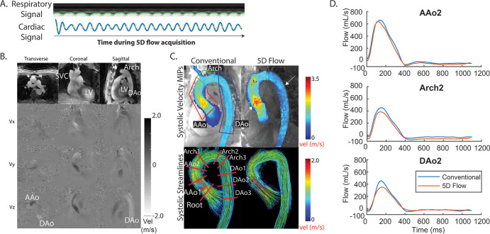 Example from a 41-year-old man with bicuspid aortic valve disease (heart rate, 52 beats per minute during imaging). A, Five-dimensional (5D) flow respiratory and cardiac signals were successfully extracted and used for binning. B, Representative magnitude- and phase-difference images show three views and three velocity (vel) directions (Vx, Vy, and Vz) for a slice and time point. C, Peak systolic maximum intensity projections (MIPs) and streamlines show good agreement between conventional and 5D flow techniques, with some overestimation in the ascending aorta (AAo) and underestimation in the arch and descending aorta (DAo) (white arrows). Peak velocity is quantified in three regions of interest (top left), and flow is evaluated over nine two-dimensional planes placed throughout the entire aorta (bottom left). D, Representative flow curves demonstrate good agreement between techniques. See corresponding Movies 1–3 (supplement). AAo2 = plane 2 of the AAo, Arch2 = plane 2 of the arch, DAo2 = plane 2 of the DAo, LV = left ventricle, SVC = superior vena cava.