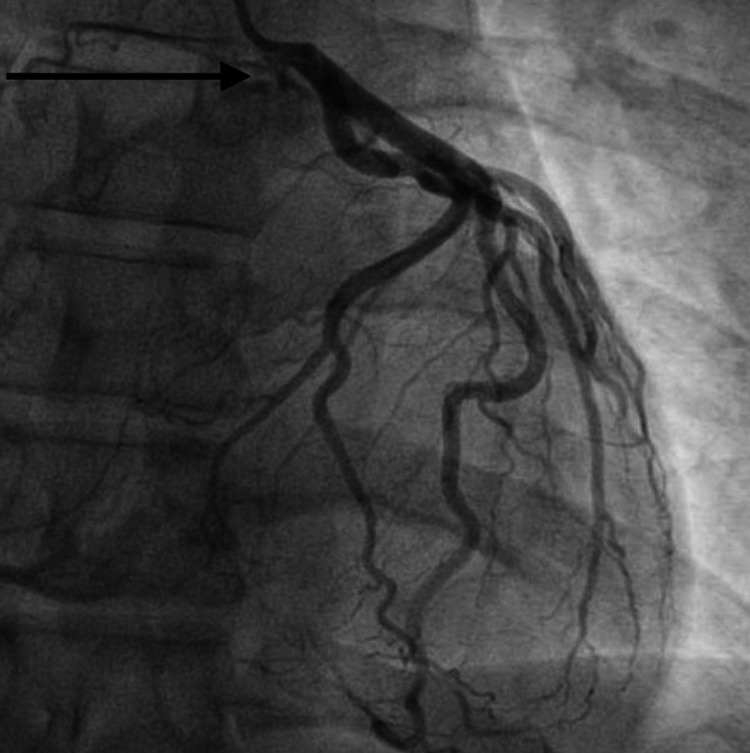 Spontaneous Coronary Artery Dissection Of An Anomalous Right Coronary 