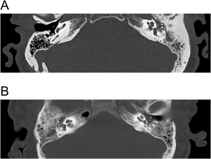 Differences in mastoid and middle-ear cavity opacification in CT ...