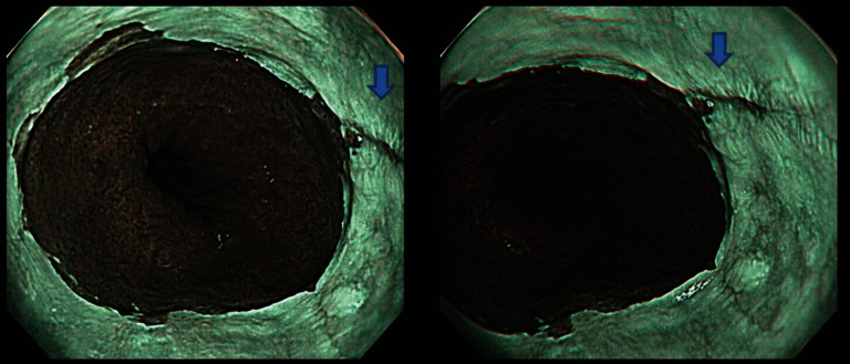 Definition of Mucosal Breaks in the Era of Magnifying Endoscopy with ...