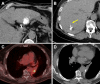 Clinical examples of intratumoral drug distribution with a radiopaque
injection agent. (A) Axial noncontrast CT image in a 61-year-old female patient
with uveal melanoma shows ideal distribution of injected drug throughout a liver
metastasis, with minimal leakage. (B) Axial noncontrast CT image in a
33-year-old male patient with uveal melanoma shows suboptimal delivery of the
same injected drug as in A, with extensive leakage along the needle track
(arrow) and outside of the tumor. (C) Axial fluorodeoxyglucose PET image in a
67-year-old female patient with lung cancer shows a lesion in the left lung
targeted for intratumoral drug delivery. (D) Axial noncontrast CT image in the
same patient as in C shows minimal deposition of the injected drug in the lung
tumor, with leakage adjacent to the lesion.