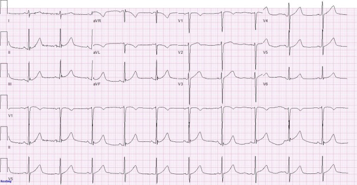 gabapentin orthostasis