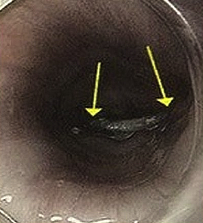 Contained esophageal perforation: “Winner, winner, chicken bone dinner ...