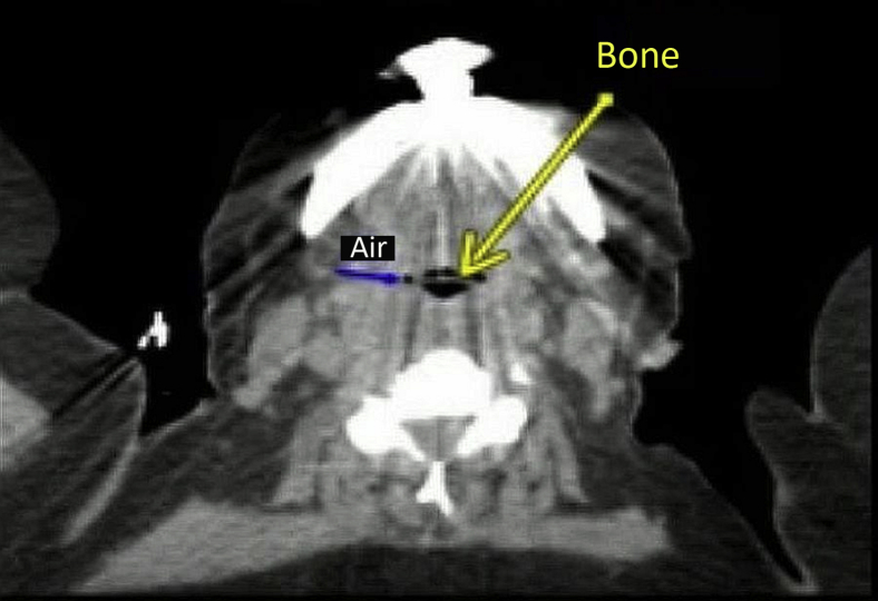 Contained esophageal perforation: “Winner, winner, chicken bone dinner ...