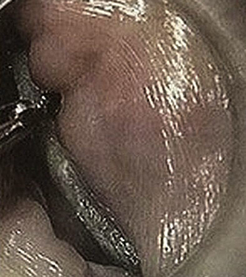 Contained esophageal perforation: “Winner, winner, chicken bone dinner ...