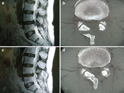 Less invasive and less technically demanding decompressive procedure ...
