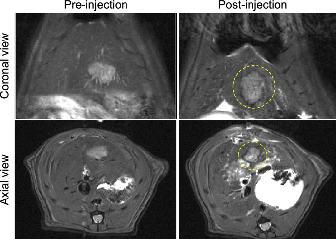 MR images obtained before and after the injection of sorafenib-eluting embolic microspheres (SOR-EMs) into the hepatic artery. Dotted circles outline regions of marked T2-weighted signal intensity changes caused by the deposition of iron oxide–labeled SOR-EMs at the typical hypervascular periphery of the tumor.