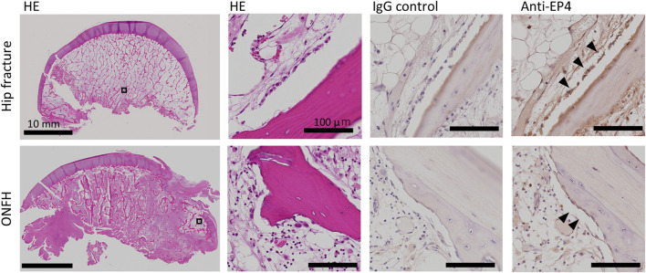 Histological images compare hip fracture (top row) and osteonecrosis of the femoral head (ONFH, bottom row). Each row shows four sections: HE staining, close-up HE staining, IgG control, and Anti-EP4 staining. HE sections reveal bone structure, while IgG control ensures staining specificity. Anti-EP4 sections highlight EP4 expression with arrowheads indicating positive staining. Scales are provided for reference.