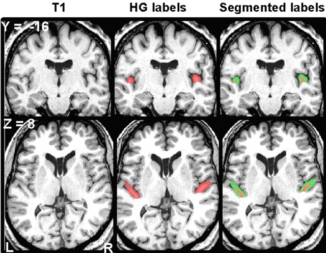 Relating Structure to Function: Heschl's Gyrus and Acoustic Processing ...