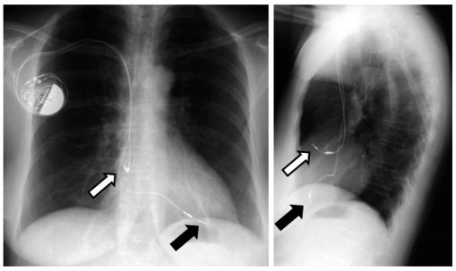 Where Does It Lead? Imaging Features Of Cardiovascular Implantable ...