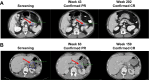 Figure 2. Representative images from patients who achieved CRs. A, Scan of a patient with pNET who had a CR at week 202. B, Scan of a patient with non-pNET (serous cystadenoma) who had a CR at week 159.