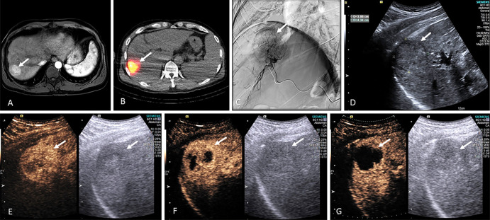 Example series of from a 54-year-old male participant undergoing hepatocellular carcinoma radioembolization with US-triggered microbubble (MB) destruction. The series shows baseline contrast-enhanced MRI scans in, A, transverse plane, B, technetium 99m macroaggregated albumin SPECT-CT in the transverse plane during treatment planning, C, angiography during yttrium 90, D, B-mode US immediately after radioembolization, and peak contrast-enhanced US enhancement during US-triggered MB destruction, E, 2 hours, F, 1 week, and, G, 2 weeks after radioembolization.