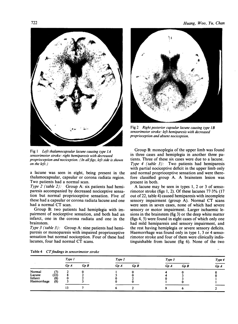 When Is Sensorimotor Stroke A Lacunar Syndrome Pmc