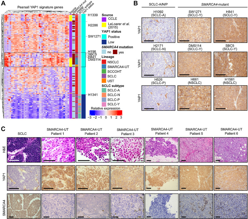 Figure 5. YAP1 is expressed in SMARCA4-UT primary samples. A, Unsupervised hierarchical clustering, based on a SCLC-specific YAP1 signature (n = 49 genes) identified by Pearsall and colleagues (10), was performed on SCCOHT and lung carcinoma samples [cell lines from the CCLE and bulk-RNA sequenced patient samples from Le Loarer and colleagues (24)]. Cell lines that cluster with the SMARCA4-UT samples are highlighted in the gray box. B, YAP1 IHC on SCLC-A/N/P and SMARCA4-mutant cell line xenografts. Scale bar = 100 μm. C, H&E, SMARCA4, and YAP1 IHC in primary SMARCA4-UT samples (n = 6) together with an SCLC patient sample. Scale bar = 100 μm.