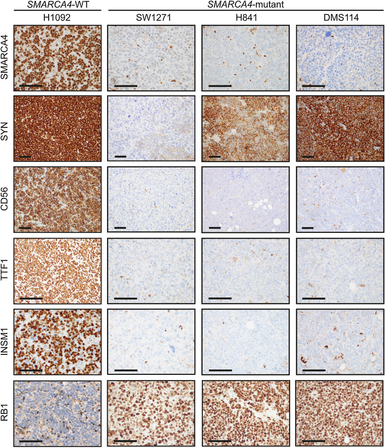 Figure 3. Distinct immunophenotype of SMARCA4-mutant compared with SMARCA4-WT SCLC cell lines. Representative IHC images of SMARCA4, synaptophysin (SYN), CD56, TTF1, INSM1, and RB1 in SMARCA4-WT, NE-high SCLC cell line (H1092) compared with SMARCA4-mutant SCLC cell lines. Scale bar = 100 μm.