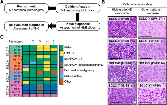 Figure 2. SMARCA4-deficient SCLC cell lines are morphologically and immunophenotypically similar to SMARCA4-UT. A, Outline of the methodology employed for assessing SMARCA4-deficient SCLC cell lines by a panel of five anatomical pathologists. B, Representative H&E images of cell line xenografts diagnosed as high-grade NE carcinoma (SCLC) and other malignant neoplasms (non-SCLC). Scale bar = 100 μm. C, Heatmap of re-evaluated diagnosis of SCLC cell line xenografts (row) and each pathologists’ classification (column). Abbreviations: LCNEC, large cell neuroendocrine cancer; SMARCA4-UT, SMARCA4-deficient undifferentiated tumor; SCLC/LCNEC, combined SCLC and LCNEC components; Other, undifferentiated tumor or small blue round cell tumor.