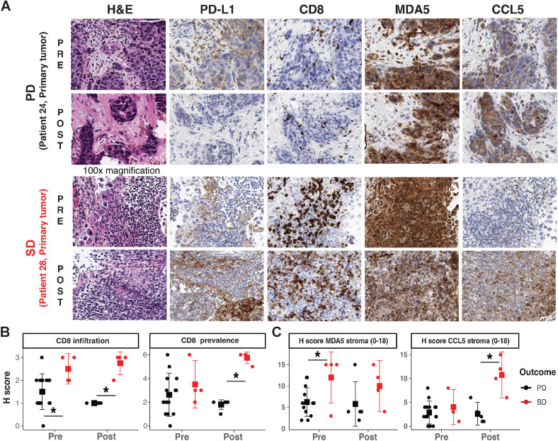 Figure 3. IHC reveals immune recruitment in tumors is associated with SD. A, Representative IHC staining of PD and SD tumors in pretreatment and posttreatment timepoint. B, IHC H-scores of CD8 infiltration status and prevalence in PD and SD tumors. C, IHC histology scores (H scores) of stromal MDA5 levels, and stromal CCL5 levels in PD and SD tumors. Statistical significance were tested with log-transformed robust linear mixed-effects models; SGPVs were used to determine if there was significant evidence of a difference where the null interval was set at ± 5% difference in regression estimates. *SGPV = 0; there were no SGPVs = 1 (i.e., no evidence of approximate equivalence). Error bars represent means ± Gini mean difference (a nonparametric measure of dispersion/spread).