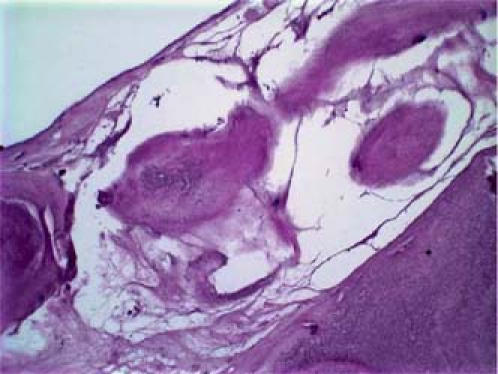 Lambl's Excrescences: Review and Recommendations - PMC