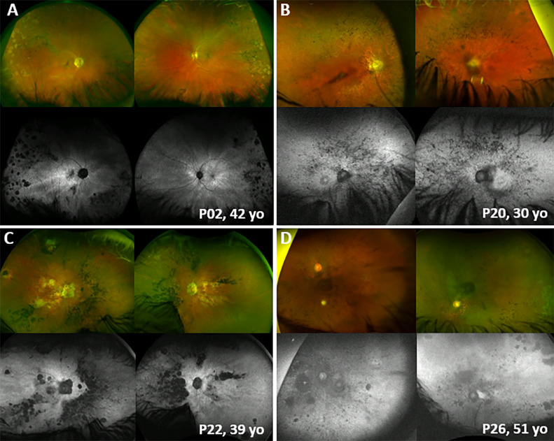 RP2-Associated X-linked Retinopathy: Clinical Findings, Molecular ...