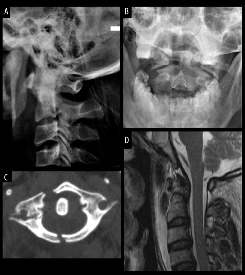 Management of Unstable C1 Fractures Involving the Lateral Mass ...