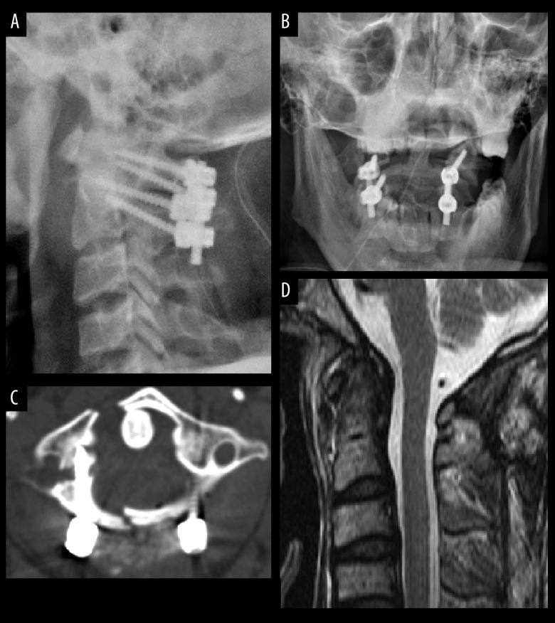 Management of Unstable C1 Fractures Involving the Lateral Mass ...