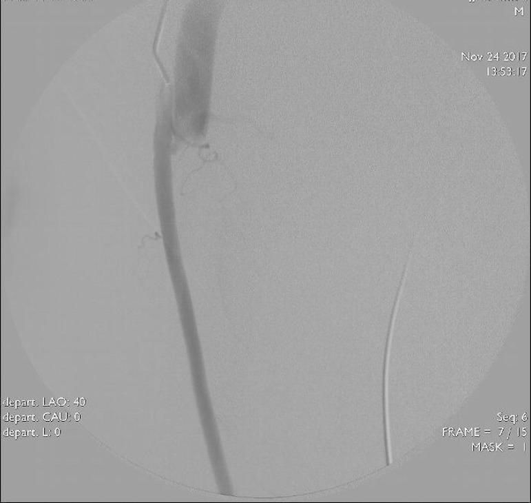 Gradual Treatment Of Arteriovenous Fistula In Femoral Vessels As A Complication Of Coronary