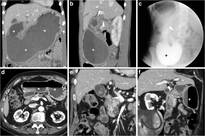 Non-perforated peptic ulcer disease: multidetector CT findings ...