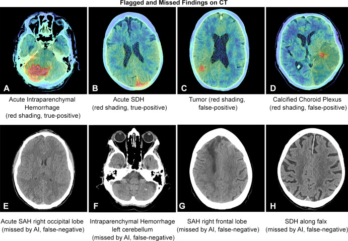 Examples of false-positive and false-negative findings on CT images. AI = artificial intelligence, SAH = subarachnoid hemorrhage, SDH = subdural hemorrhage.