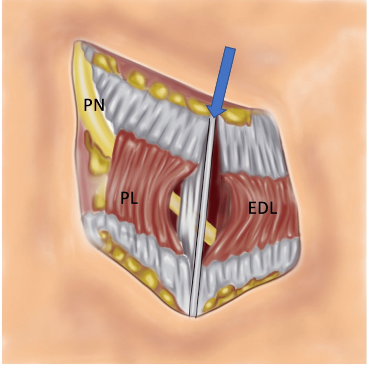 Common Peroneal Nerve Palsy at the Level of Proximal Fibula After Total ...