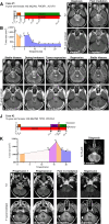 Figure 6. ONC201 in combination with paxalisib drives tumor regression and increased survival in DIPG case studies. A, Six-year-old H3.1K27M, PIK3R1, ACVR1 mutant patient with DIPG underwent biopsy soon after diagnosis and received 54 Gy radiotherapy over 30 fractions. MRI was performed six weeks after the completion of radiotherapy, and compassionate access was granted for the use of paxalisib to target PIK3R1 mutations. Family of the patient sourced German ONC201 and started concurrently with paxalisib. B, Tumor size at diagnosis, following radiotherapy and throughout treatment. C, T2 and T1 after contrast MR axial scans at patient diagnosis, tumor area = 1,554 mm2. D, Following radiotherapy, tumor area decreased by 38.1% to 962 mm2 compared with diagnosis. E, MRI showed that tumor area was stable following radiotherapy = 1,156 mm2, 20.2% progression. Following this scan, the ONC201 (15 mg/kg once a week) and paxalisib (27 mg/m2 daily) combination was started. F, MRI following 8 weeks on the combination tumor area was stable (1,224 mm2), 6% increase. G, Tumor regression was seen after 20 weeks on the drug combination. Tumor area = 464 mm2; tumor reduction by 62% compared with the last scan. H, Most recent MRI. Tumor area = 306 mm2; total tumor area reduction compared with diagnosis = 80%. I, The patient continues to remain on the combination 22 months following diagnosis. J–P, Sixteen-year-old H3.3K27M, TP53, PIK3CA mutant patient with DIPG received 54 Gy over 30 fractions. Patient enrolled in the ONC201 monotherapy trial NCT03416530 and experienced stable disease for 2 months. Following radiological and clinical progression, the patient received panobinostat (45 mg daily three times a week) with ONC201 (625 mg once a week). Further progression was seen in the subsequent MRI, where the patient then received reirradiation. The patient immediately commenced ONC201 and paxalisib, both on compassionate grounds. K, Tumor area measured throughout treatment. L, T2 and T1 after contrast MR axial scans at patient diagnosis. Tumor area = 977.8 mm2. M, MRI following first progression. Tumor area = 1,303.3 mm2. N, Patient received panobinostat in combination with ONC201; MRI image following the combination. Tumor area = 1,814 mm2. Following, this patient received reirradiation and ONC201 (15 mg/kg once a week) and paxalisib (27 mg/m2 daily) O, Tumor regression was seen 8 weeks after re-RT, while receiving ONC201 in combination with paxalisib. Tumor area = 1,322.6 mm2. P, Tumor regression was again seen after 20 weeks on the combination; tumor area = 1,209 mm2, 20 months after diagnosis. Patient continued to receive ONC201 and paxalisib for the next 3 months and then contracted pneumonia and passed away 24 months from diagnosis.