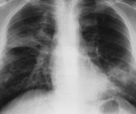 Multifocal Ill-Defined Opacities - PMC