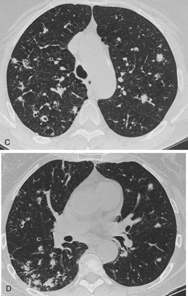 Multifocal Ill-Defined Opacities - PMC